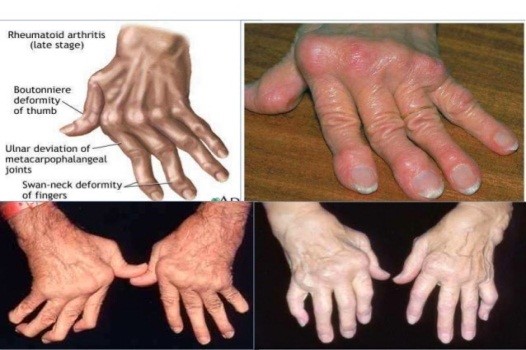 Nguyên nhân và dấu hiệu nhận biết của bệnh phong